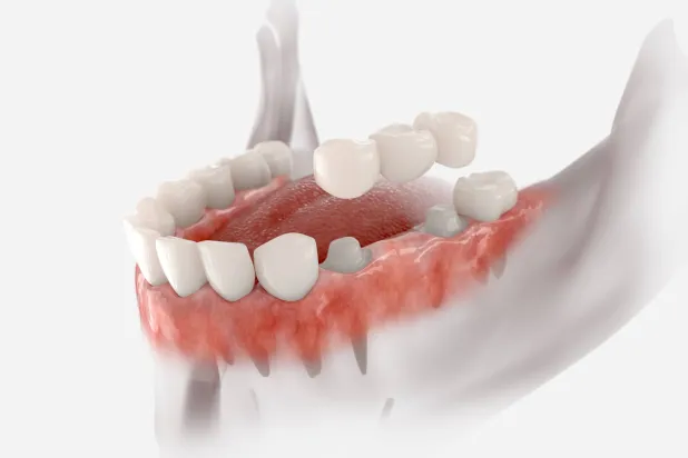 الذكاء الاصطناعي في طب الأسنان الترميمي